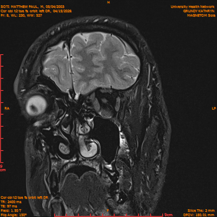 2026-04-15/Brain/Cor obl t2 tse fs orbit left DR/0009-IM240.png