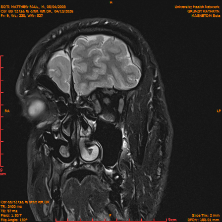2026-04-15/Brain/Cor obl t2 tse fs orbit left DR/0010-IM241.png