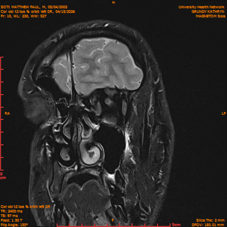2026-04-15/Brain/Cor obl t2 tse fs orbit left DR/0011-IM242.png