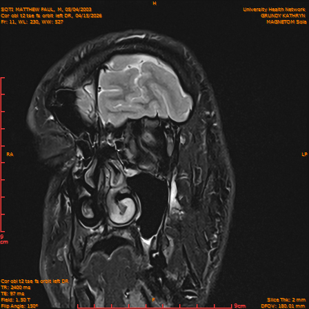 2026-04-15/Brain/Cor obl t2 tse fs orbit left DR/0012-IM243.png