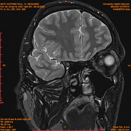 2026-04-15/Brain/Cor obl t2 tse fs orbit right DR/0001-IM220.png