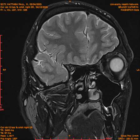 2026-04-15/Brain/Cor obl t2 tse fs orbit right DR/0002-IM221.png