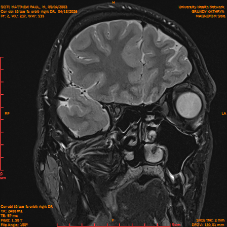 2026-04-15/Brain/Cor obl t2 tse fs orbit right DR/0003-IM222.png