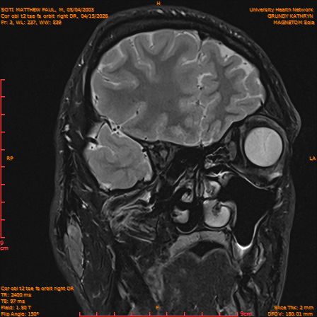 2026-04-15/Brain/Cor obl t2 tse fs orbit right DR/0004-IM223.png