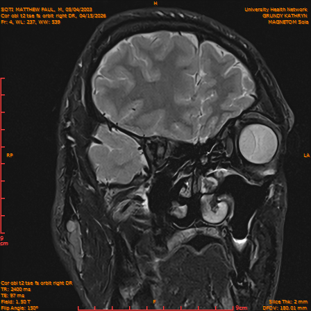 2026-04-15/Brain/Cor obl t2 tse fs orbit right DR/0005-IM224.png