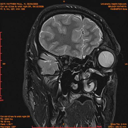 2026-04-15/Brain/Cor obl t2 tse fs orbit right DR/0006-IM225.png