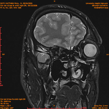 2026-04-15/Brain/Cor obl t2 tse fs orbit right DR/0007-IM226.png
