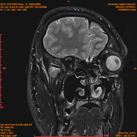 2026-04-15/Brain/Cor obl t2 tse fs orbit right DR/0008-IM227.png
