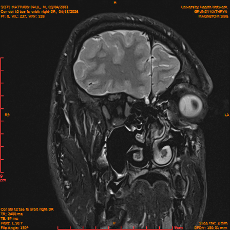 2026-04-15/Brain/Cor obl t2 tse fs orbit right DR/0009-IM228.png