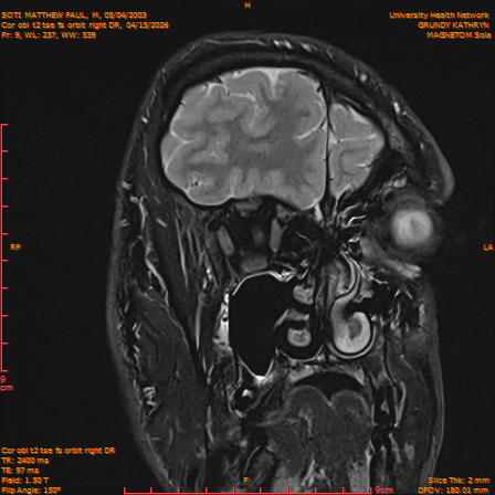 2026-04-15/Brain/Cor obl t2 tse fs orbit right DR/0010-IM229.png