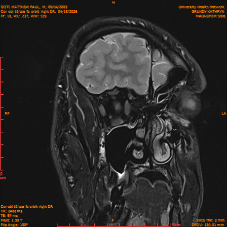 2026-04-15/Brain/Cor obl t2 tse fs orbit right DR/0011-IM230.png