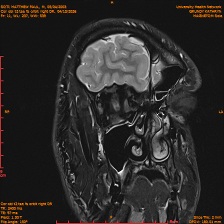 2026-04-15/Brain/Cor obl t2 tse fs orbit right DR/0012-IM231.png
