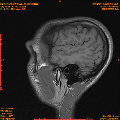 2026-04-15/Brain/Sag t1 se DR/0005-IM162.png
