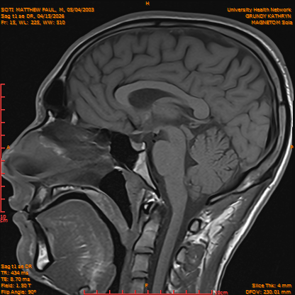 2026-04-15/Brain/Sag t1 se DR/0016-IM173.png