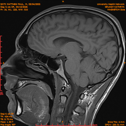 2026-04-15/Brain/Sag t1 se DR/0017-IM174.png