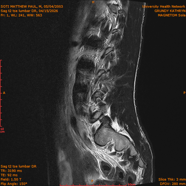 2026-04-15/Brain/Sag t2 tse lumbar DR/0002-.png
