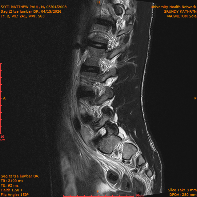 2026-04-15/Brain/Sag t2 tse lumbar DR/0003-.png