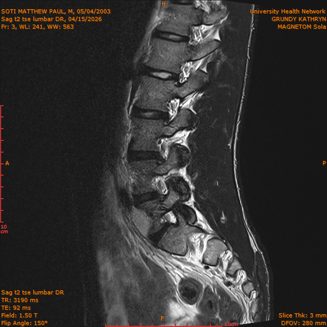 2026-04-15/Brain/Sag t2 tse lumbar DR/0004-.png