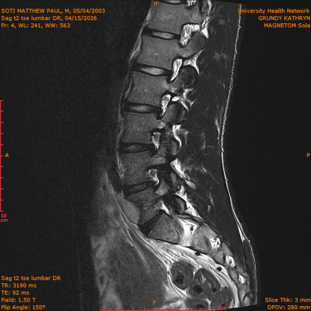 2026-04-15/Brain/Sag t2 tse lumbar DR/0005-.png