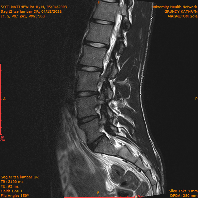 2026-04-15/Brain/Sag t2 tse lumbar DR/0006-.png