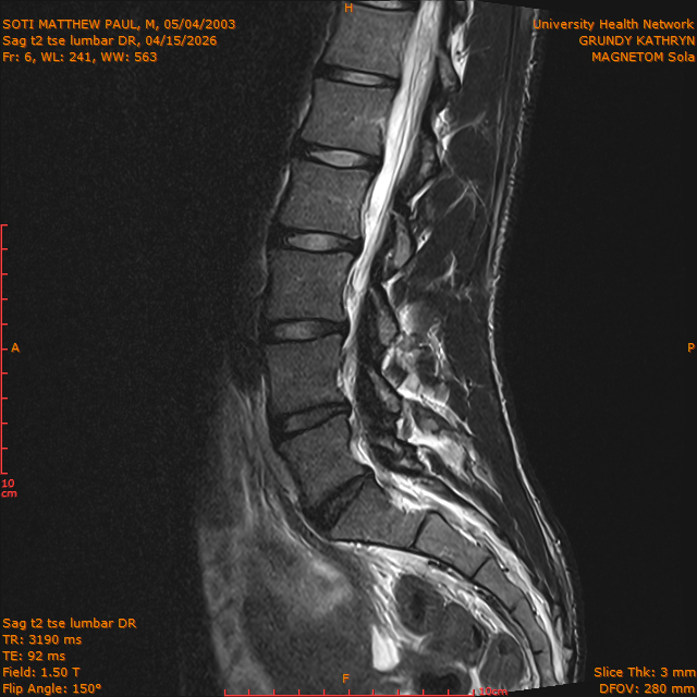 2026-04-15/Brain/Sag t2 tse lumbar DR/0007-.png
