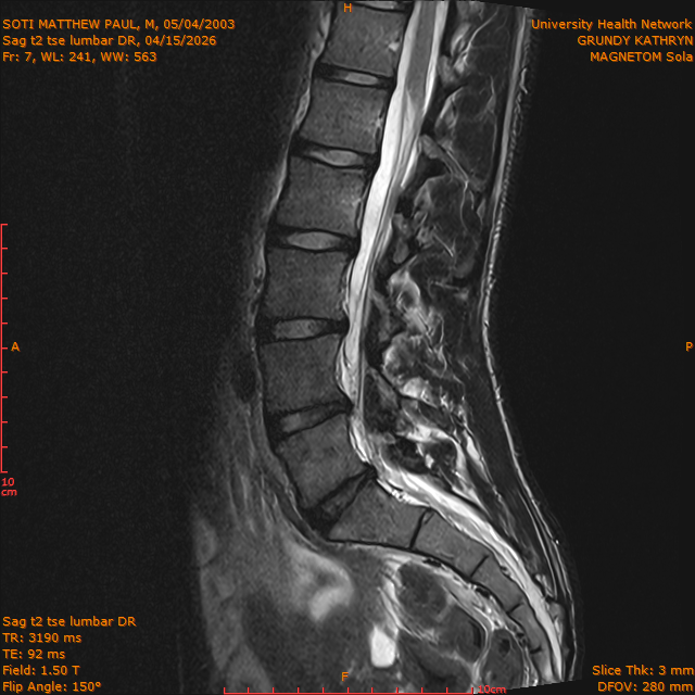 2026-04-15/Brain/Sag t2 tse lumbar DR/0008-.png