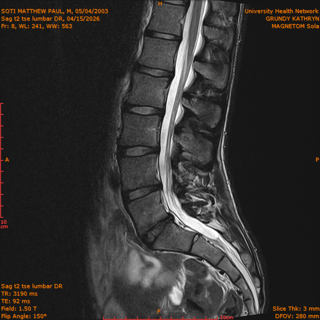 2026-04-15/Brain/Sag t2 tse lumbar DR/0009-.png