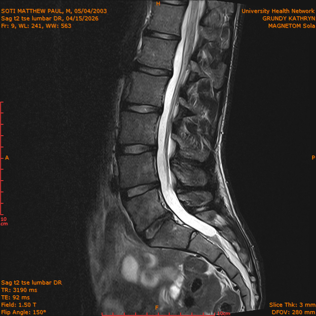 2026-04-15/Brain/Sag t2 tse lumbar DR/0010-.png