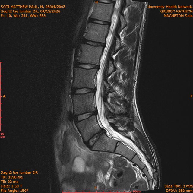 2026-04-15/Brain/Sag t2 tse lumbar DR/0011-.png