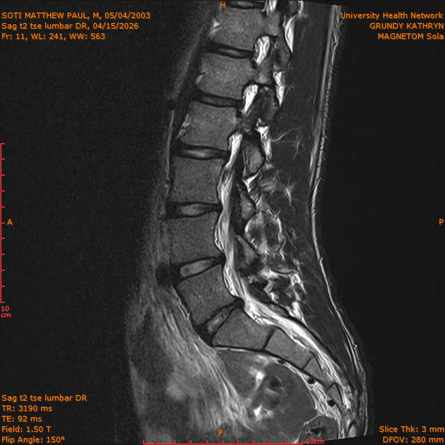 2026-04-15/Brain/Sag t2 tse lumbar DR/0012-.png