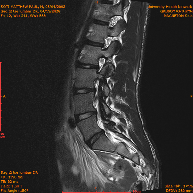 2026-04-15/Brain/Sag t2 tse lumbar DR/0013-.png