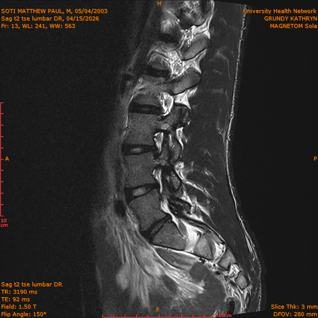 2026-04-15/Brain/Sag t2 tse lumbar DR/0014-.png