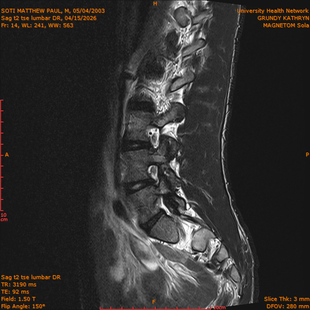 2026-04-15/Brain/Sag t2 tse lumbar DR/0015-.png