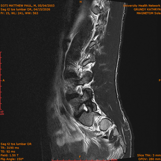 2026-04-15/Brain/Sag t2 tse lumbar DR/0016-.png
