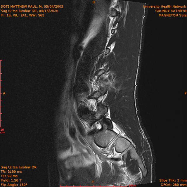 2026-04-15/Brain/Sag t2 tse lumbar DR/0017-.png