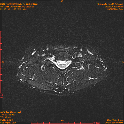 2026-04-15/Entire Spine/Aax t2 tse DR cervical/0018-.png