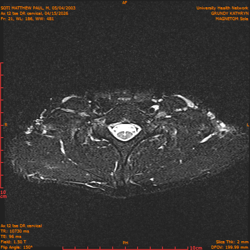 2026-04-15/Entire Spine/Aax t2 tse DR cervical/0022-.png