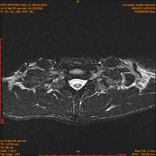 2026-04-15/Entire Spine/Aax t2 tse DR cervical/0025-.png