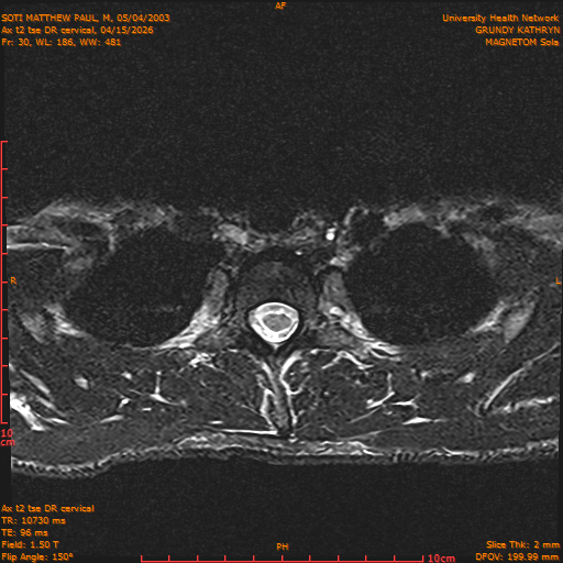 2026-04-15/Entire Spine/Aax t2 tse DR cervical/0031-.png