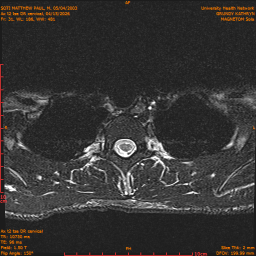 2026-04-15/Entire Spine/Aax t2 tse DR cervical/0032-.png