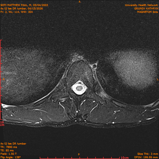 2026-04-15/Entire Spine/Ax t2 tse DR lumbar/0003-IM113.png