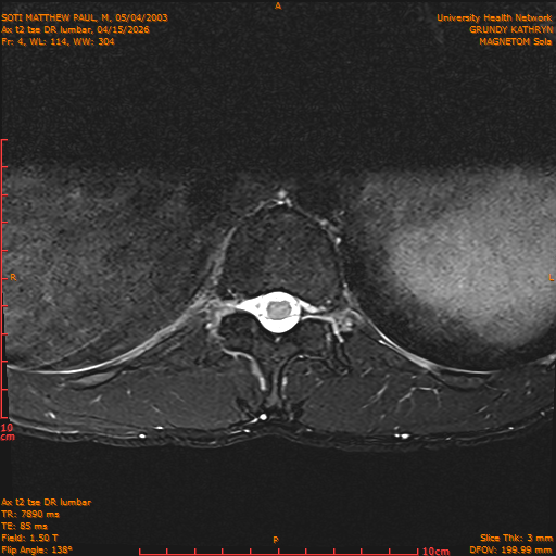 2026-04-15/Entire Spine/Ax t2 tse DR lumbar/0005-IM115.png