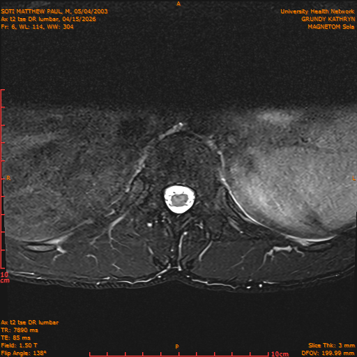 2026-04-15/Entire Spine/Ax t2 tse DR lumbar/0007-IM117.png