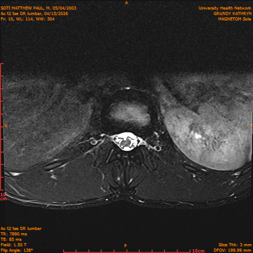 2026-04-15/Entire Spine/Ax t2 tse DR lumbar/0011-IM121.png