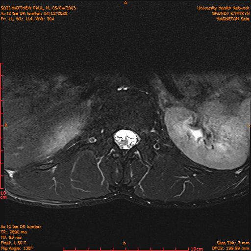 2026-04-15/Entire Spine/Ax t2 tse DR lumbar/0012-IM122.png