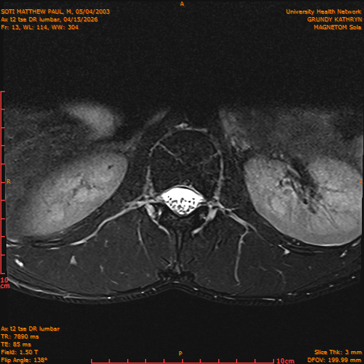 2026-04-15/Entire Spine/Ax t2 tse DR lumbar/0014-IM124.png