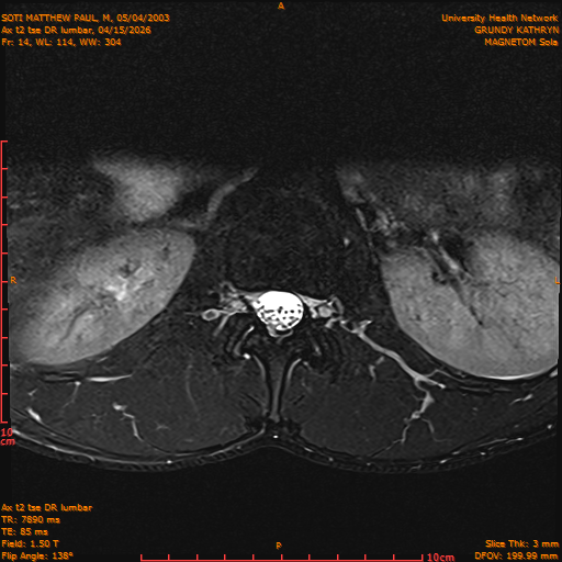 2026-04-15/Entire Spine/Ax t2 tse DR lumbar/0015-IM125.png