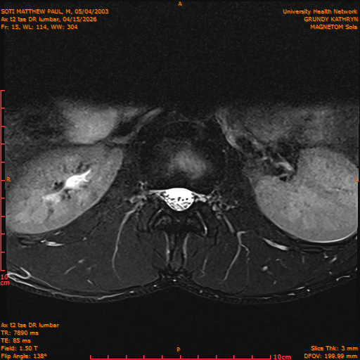 2026-04-15/Entire Spine/Ax t2 tse DR lumbar/0016-IM126.png