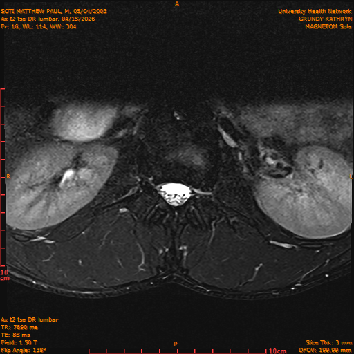 2026-04-15/Entire Spine/Ax t2 tse DR lumbar/0017-IM127.png