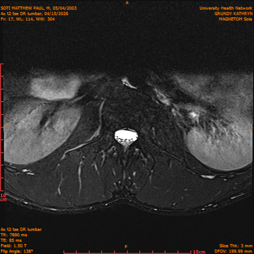 2026-04-15/Entire Spine/Ax t2 tse DR lumbar/0018-IM128.png
